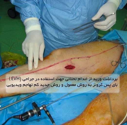 جراحی برداشت ورید