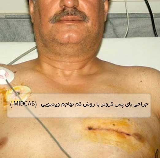 جراحی بای پس کرونر